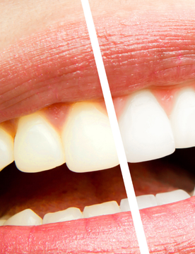 Sbiancamento denti induce una sensazione di rilassamento ed euforia (7)